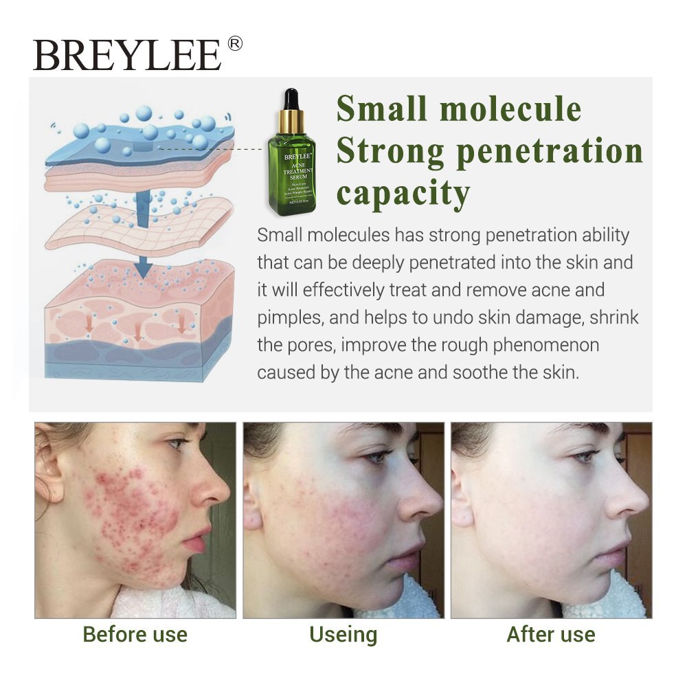 Hydrating acne treatment serum for clear skin