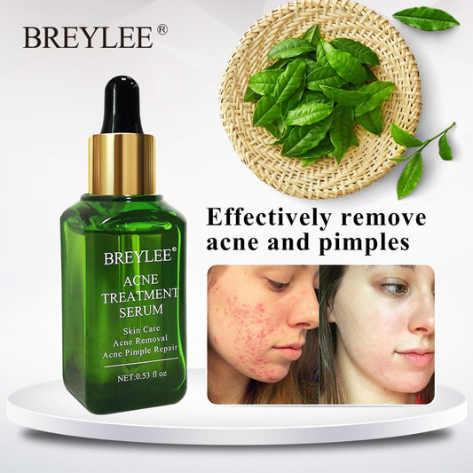 Hydrating acne treatment serum for clear skin