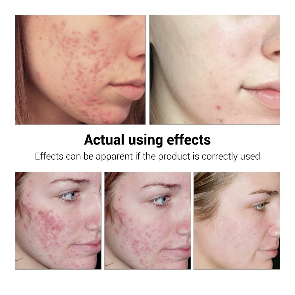 Hydrating acne treatment serum for clear skin