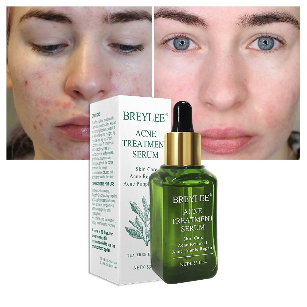 Hydrating acne treatment serum for clear skin